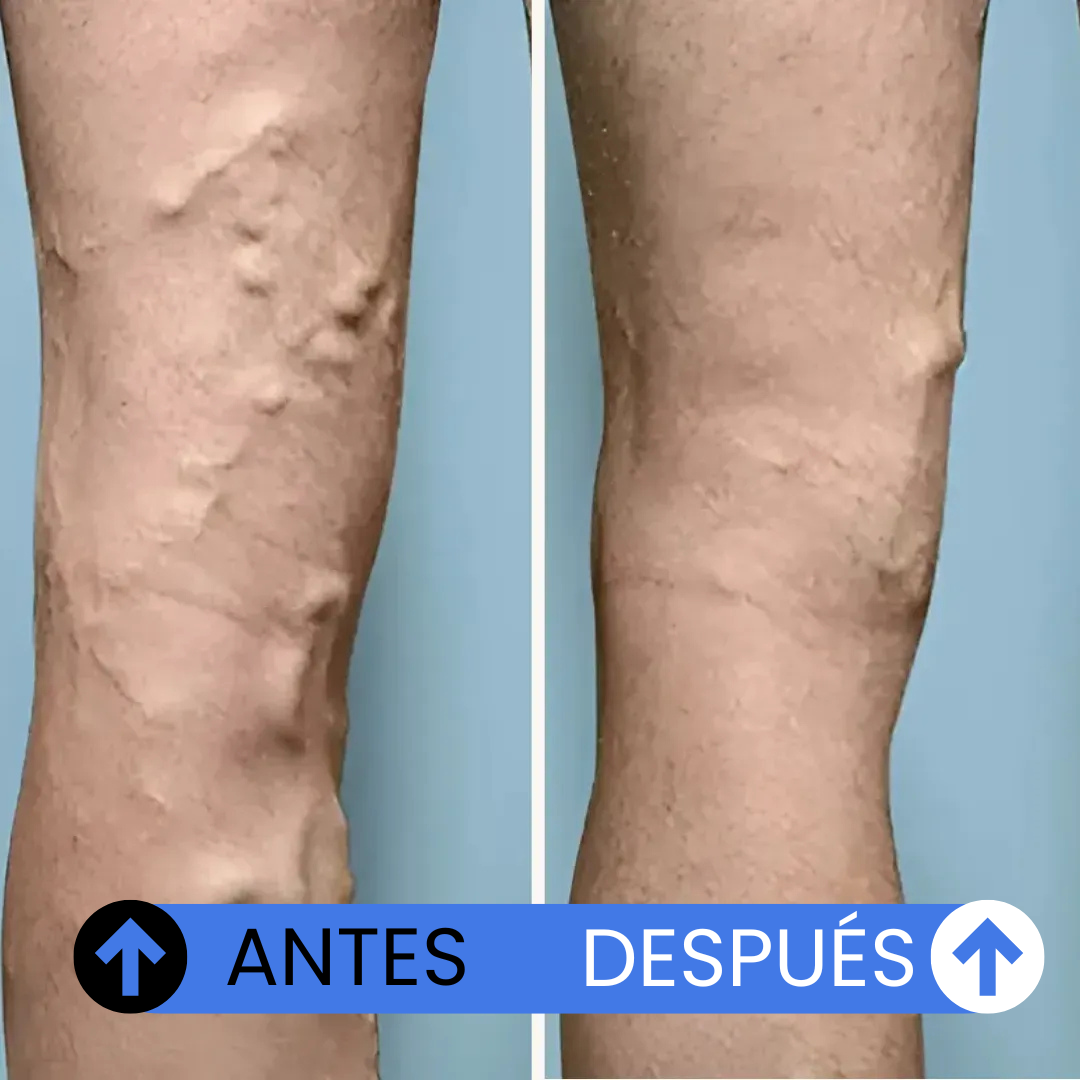 Medias Antifatiga para Piernas Livianas y Sin Várices - Veinguard™