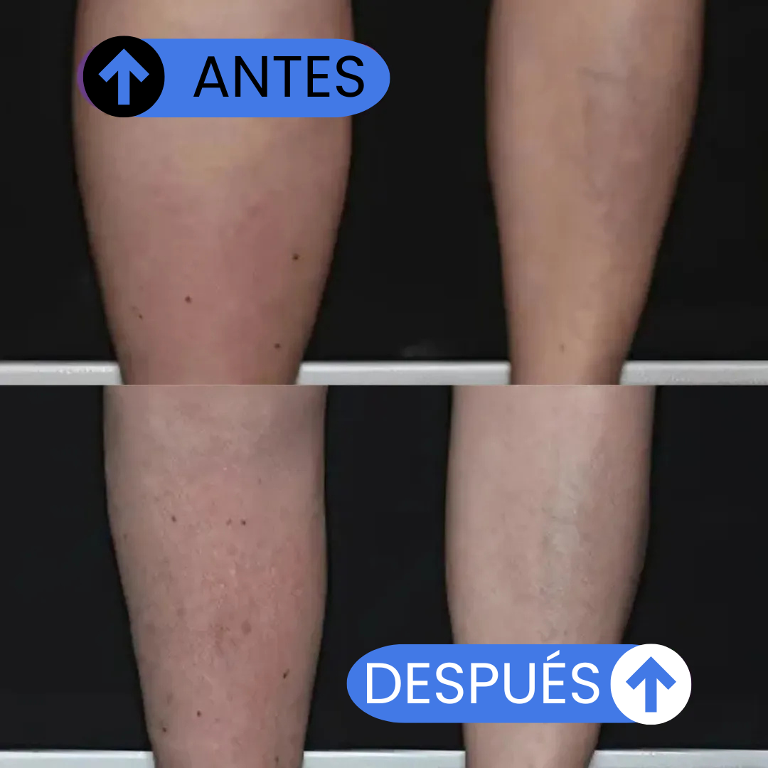 Medias Antifatiga para Piernas Livianas y Sin Várices - Veinguard™