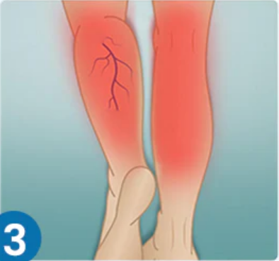 VEINGUARD Herbal Spray image VEINGUARD Herbal Spray